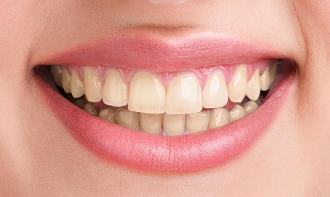 Ventajas del blanqueamiento dental