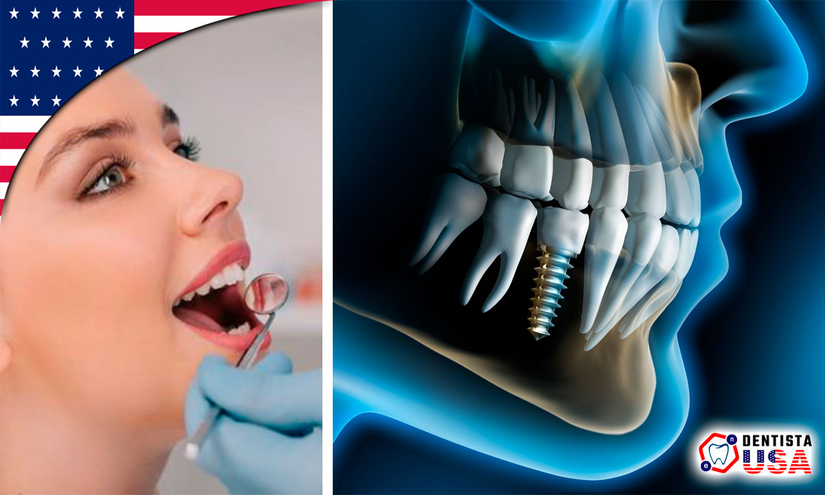 implantes dentales