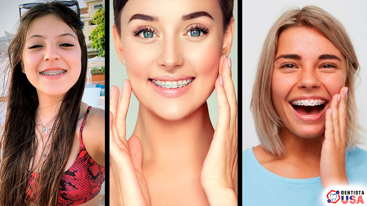 Brackets económicos: Tratamientos Dentales de Alta Calidad a Precios Accesibles