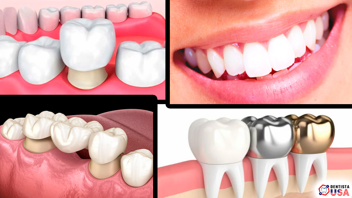 Coronas Dentales Económicas: Recupera tu Sonrisa Hoy Mismo
