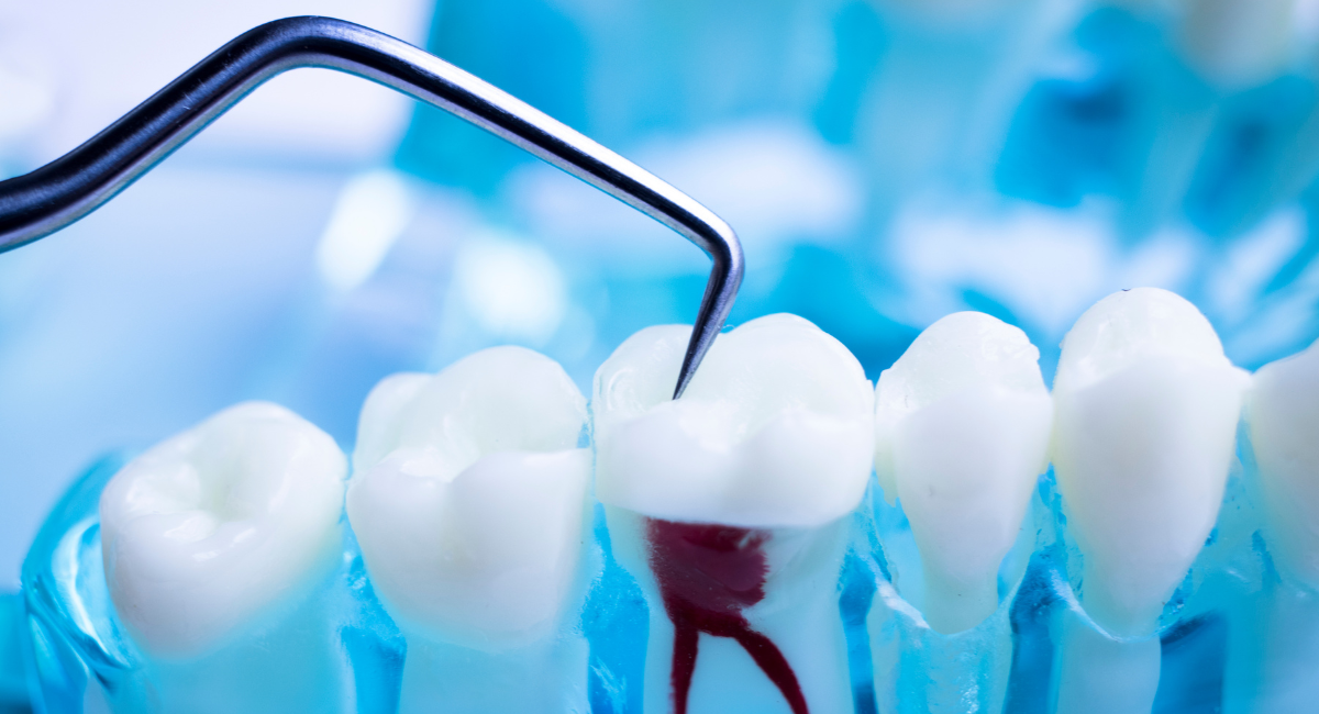 ¿Cuánto cuesta una endodoncia en los Estados Unidos?